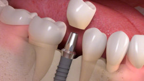 dental-implants-600×400