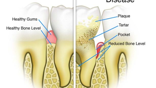 healthy-vs-gum-disease