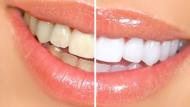 remedies_home_yellow_teeth-759×438