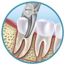 Poza 51 - extractie-dentara-1