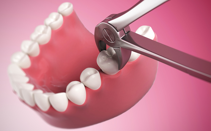 Human tooth being removed, illustration