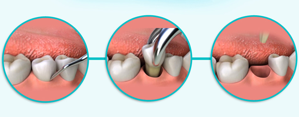 Poza 53 - extractia-dentara-2