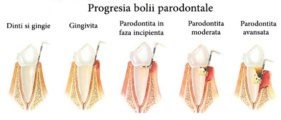 Poza 71 - Bolile-Parodontale